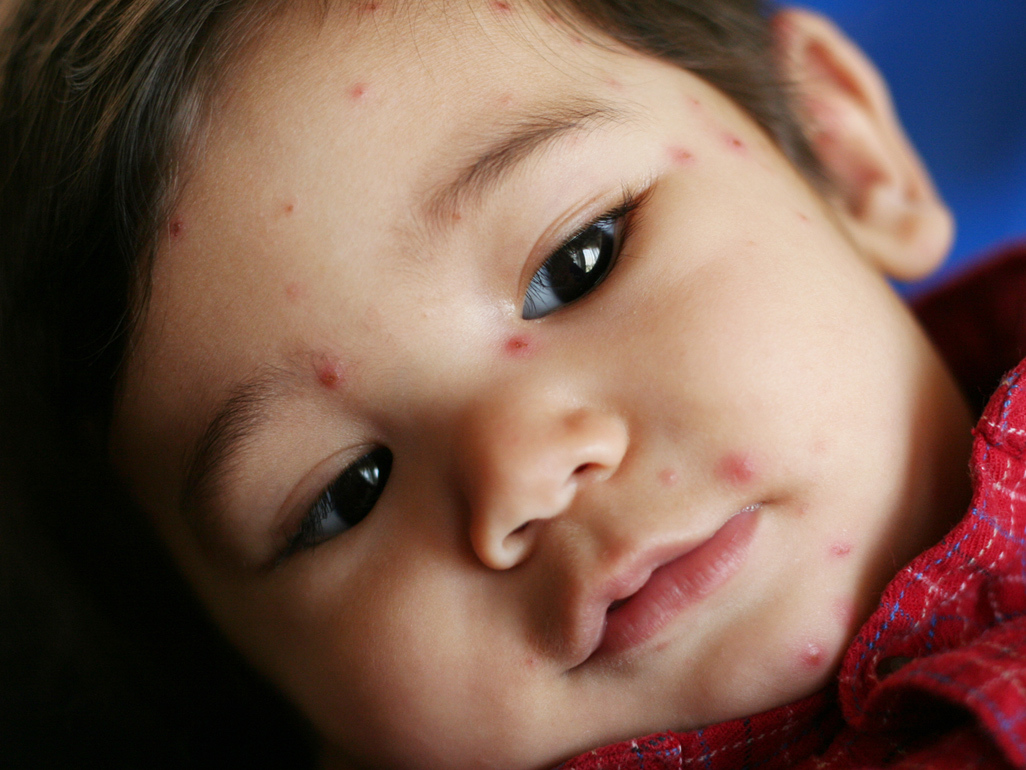 boy with rash on his face