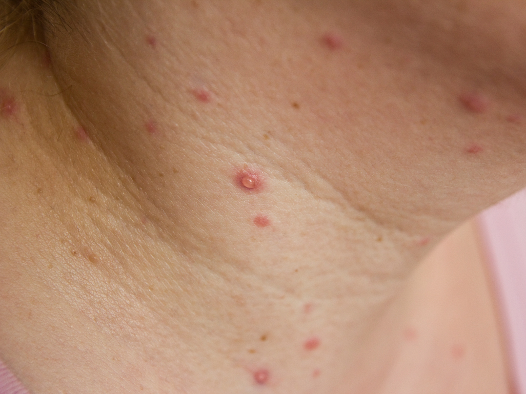 close-up of skin with pink spots with raised bumps