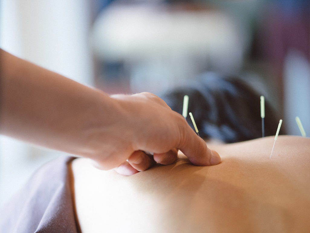 close up of acupuncture needles on a woman's back